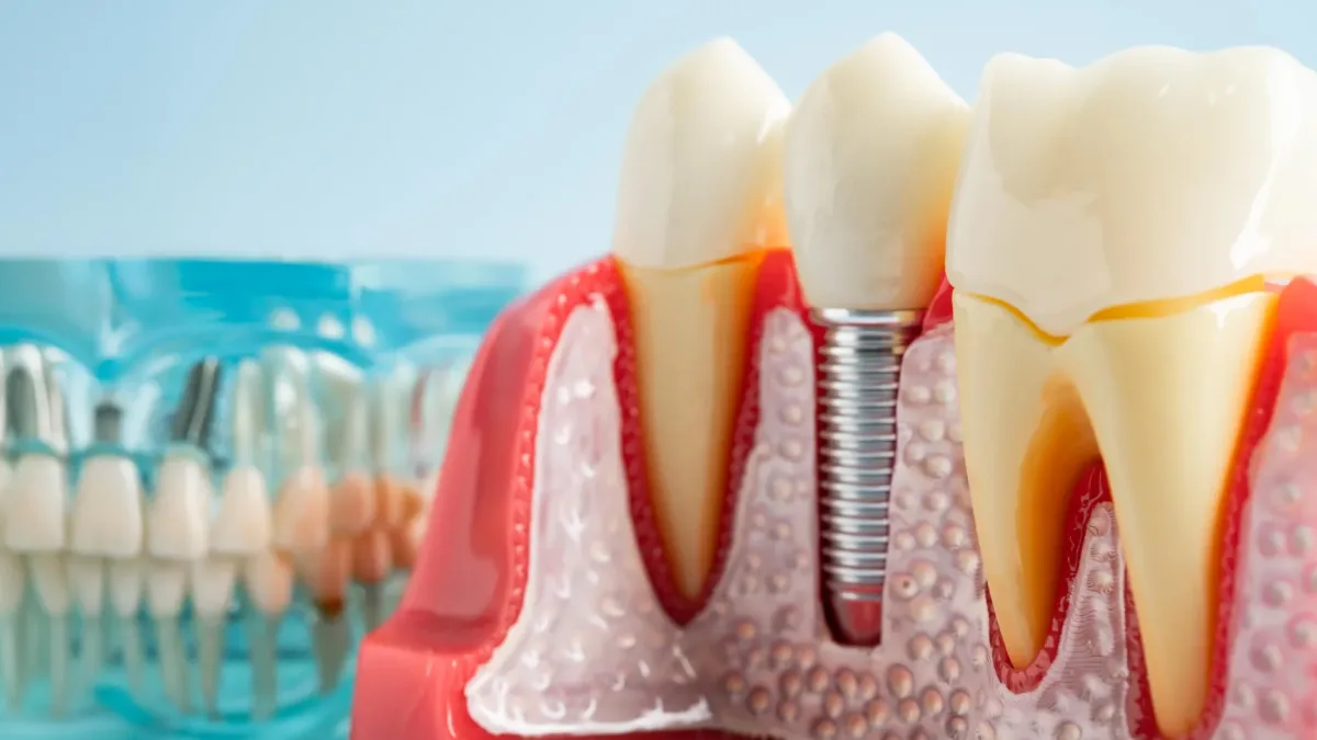Dental implant patient during a check-up